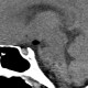 Hamartoma of tuber cinereum: CT - Computed tomography
